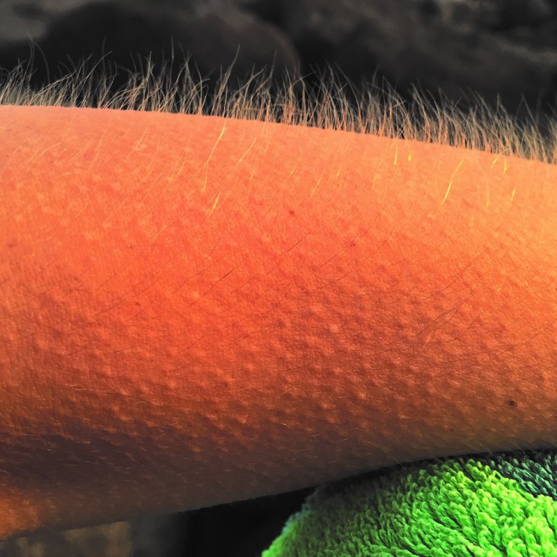 Гусииное кожа