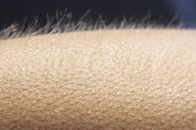 Фолликулярный гиперкератоз гусиная кожа