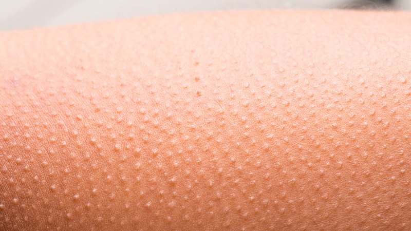 Гиперкератоз фолликулярный гиперкератоз