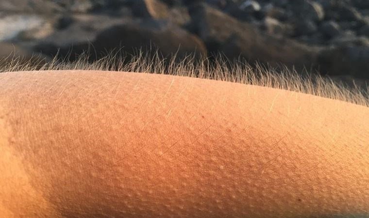 Фолликулярный фолликулярный гиперкератоз