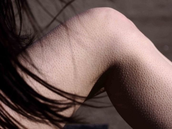 Гиперкератоз фолликулярный гиперкератоз