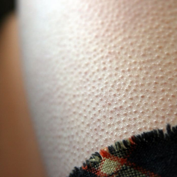 Гиперкератоз гусиная кожа